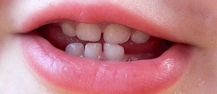 دندان های شیری