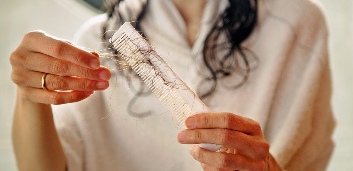 ریزش ارثی مو