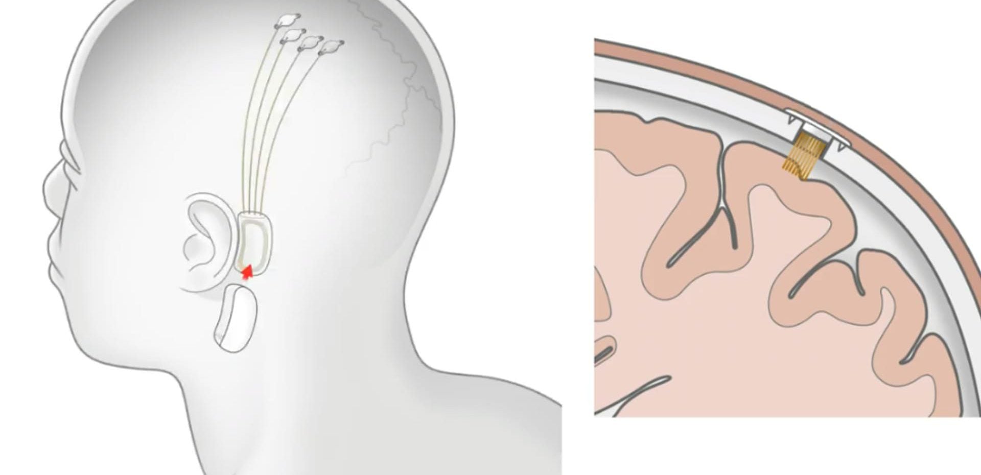 Neuralink