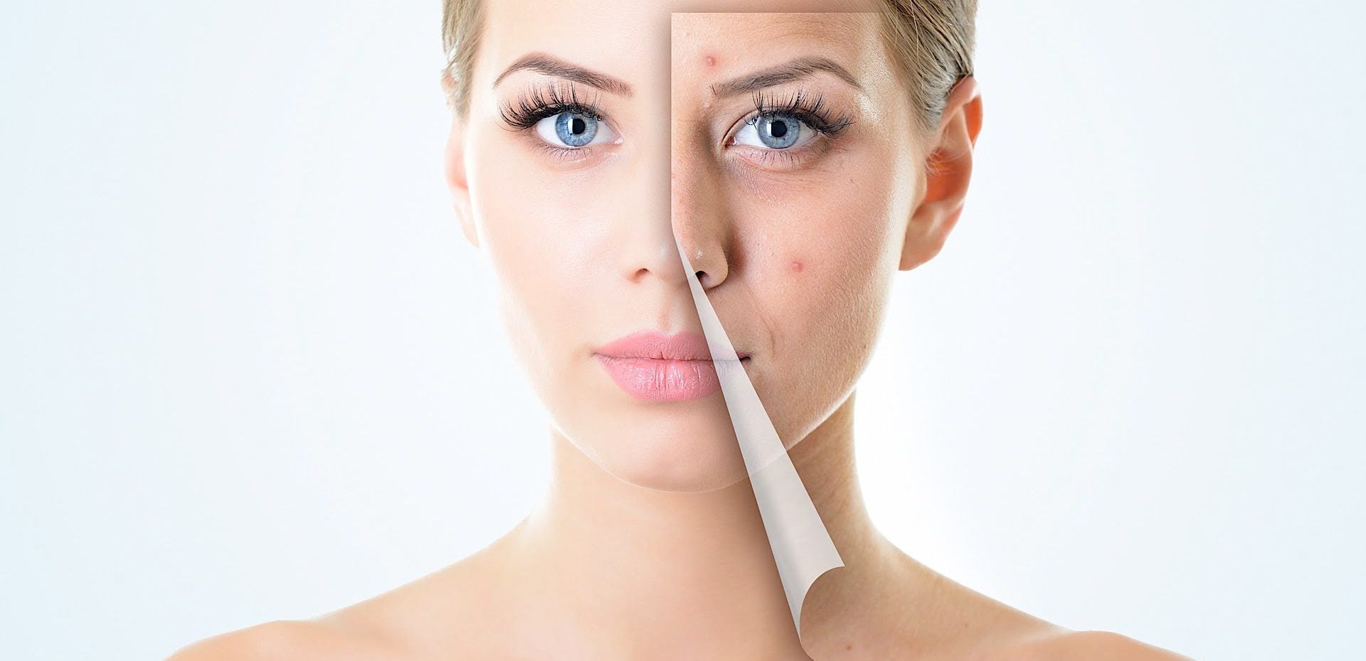 آکنه‌های پوست