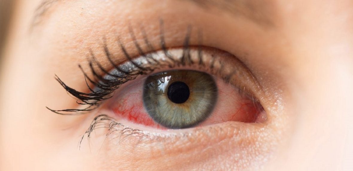 آبگرفتگی چشم