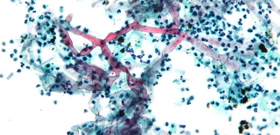 بیماری قارچ سیاه چیست