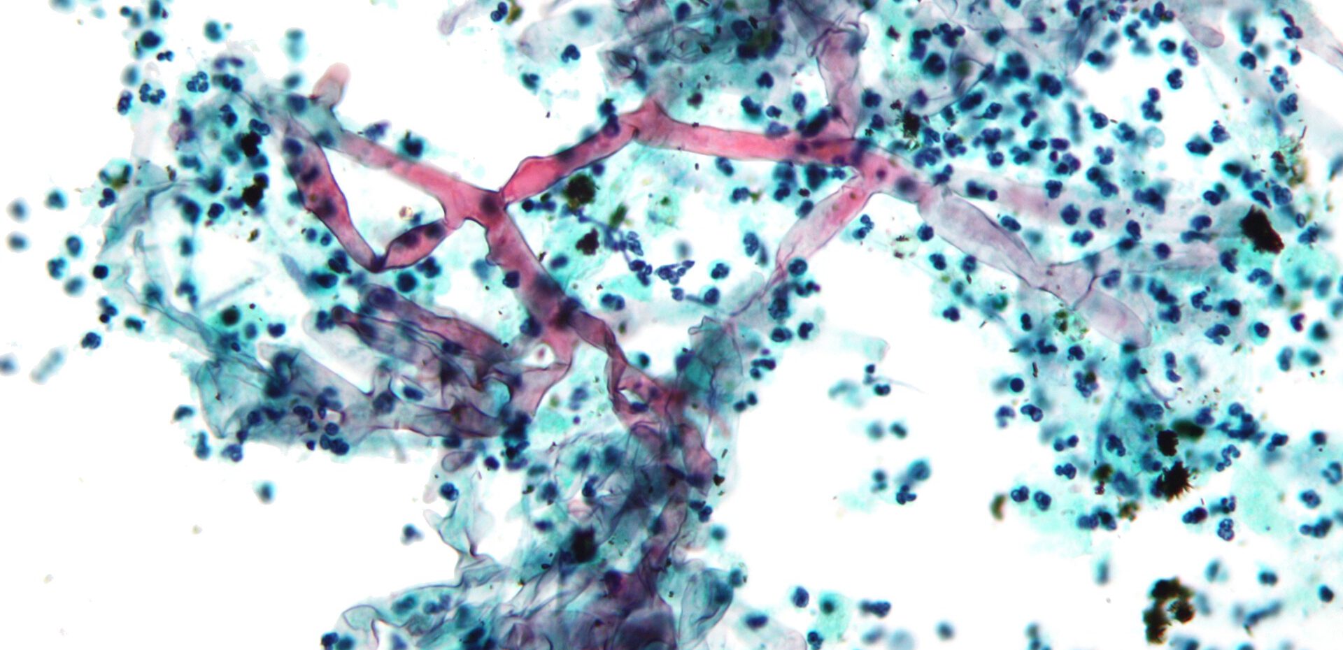 بیماری قارچ سیاه چیست