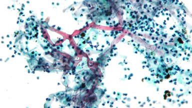 بیماری قارچ سیاه چیست