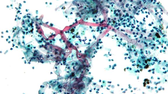 بیماری قارچ سیاه چیست