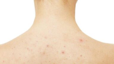 دلایل جوش زدن بدن