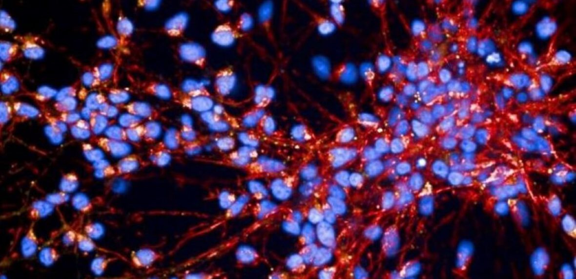 بیماری پارکینسون