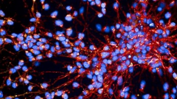 بیماری پارکینسون